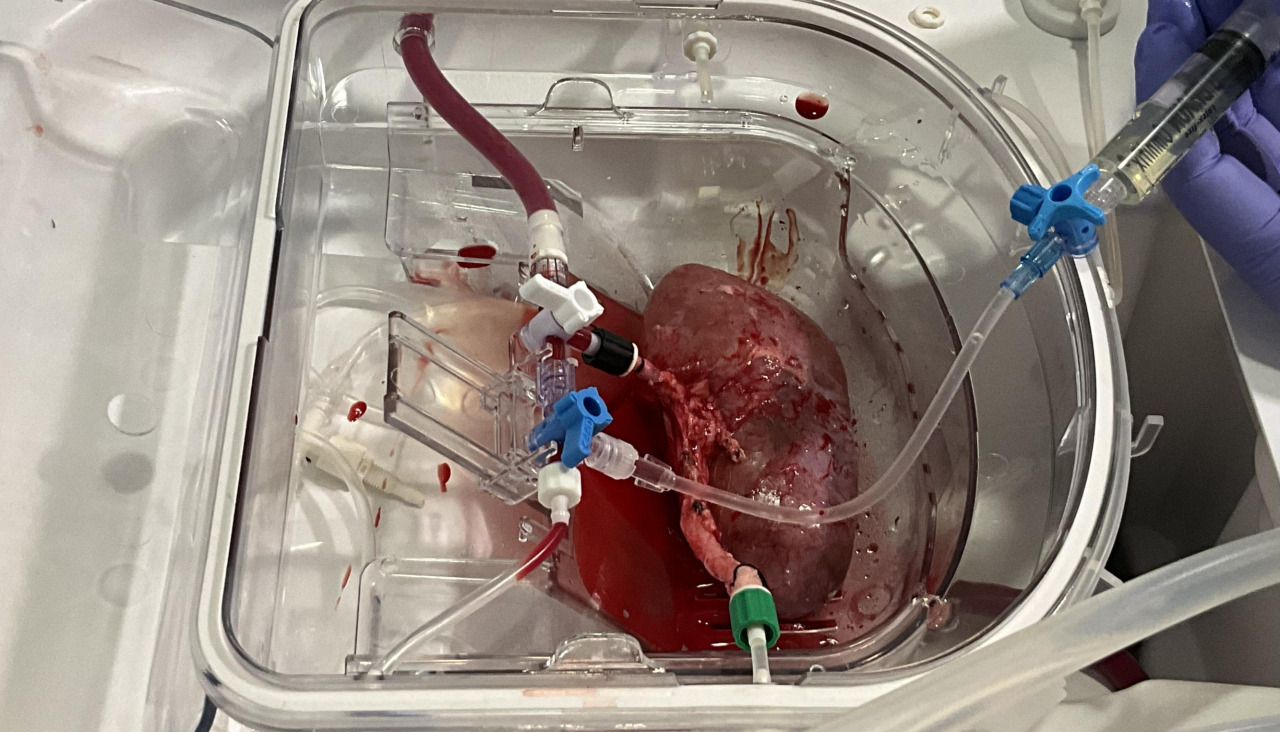 Momento de la infusión de los organoides en el riñón porcino