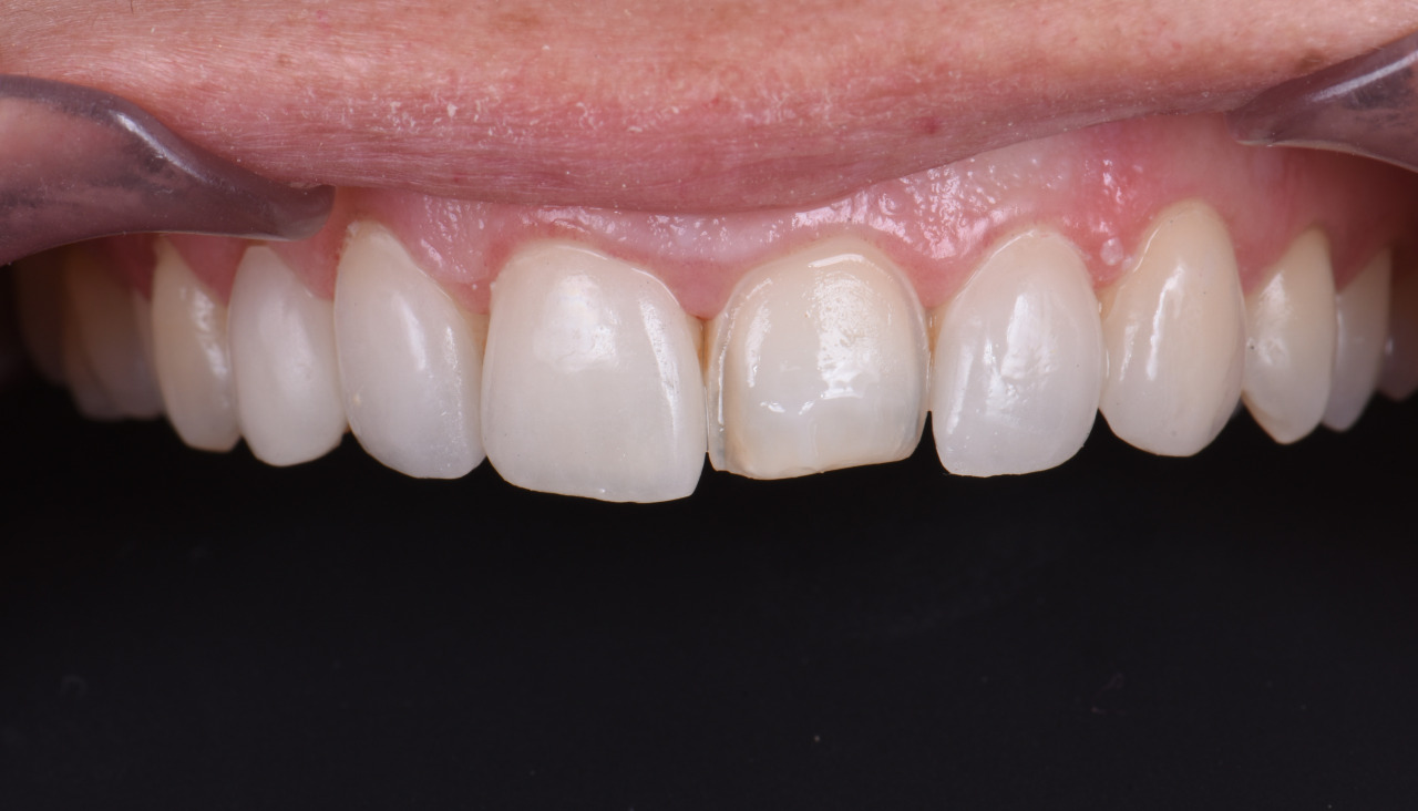 La dentadura antes 