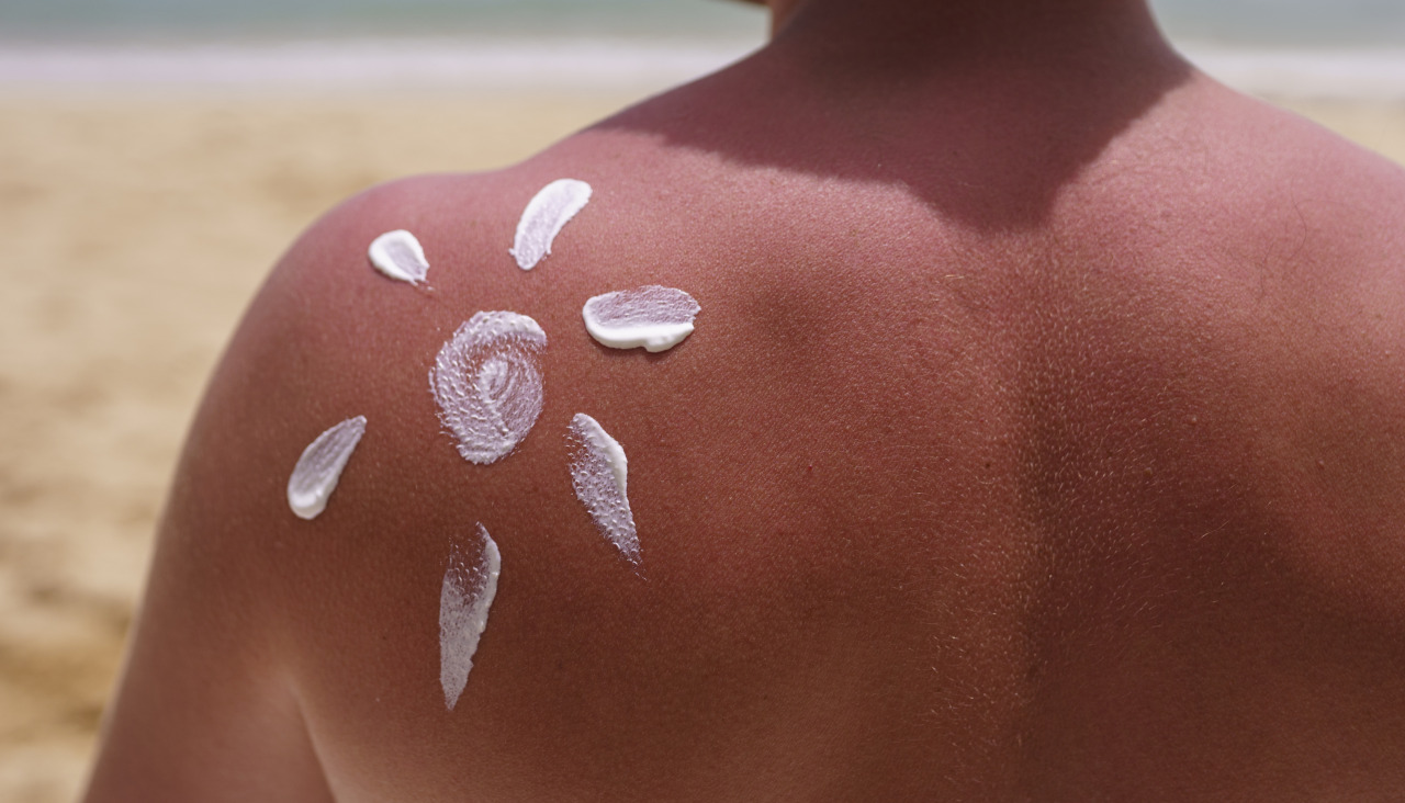 Vista del hombre aplicando locion en la piel quemada por el sol en la playa