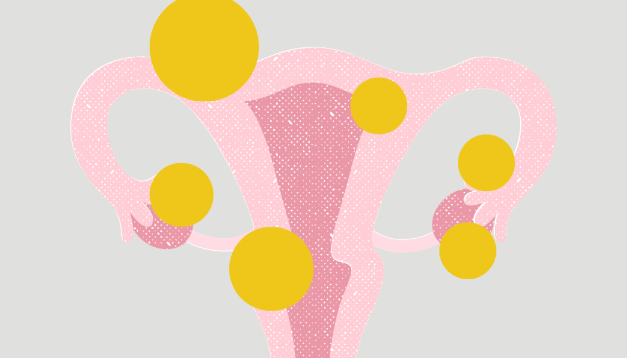 Desde la asociaciou0301nu00a0Querendo: mulleres con endometriose, que cumple este 2025 diez anu0303os de actividad, buscan visibilizar la enfermedad